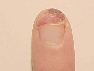 nail growth