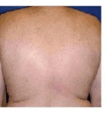laser hair removal