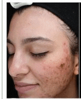 dermaplaning