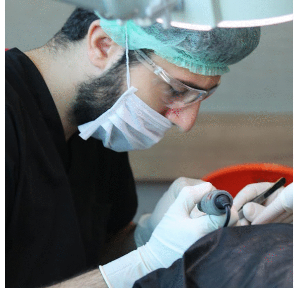 FUE hair transplant