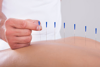 Acupuncture for back pain London, https://www.londonacupunctureroom.com/