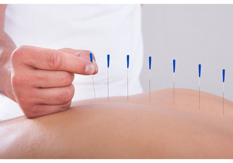 Acupuncture for pain central London