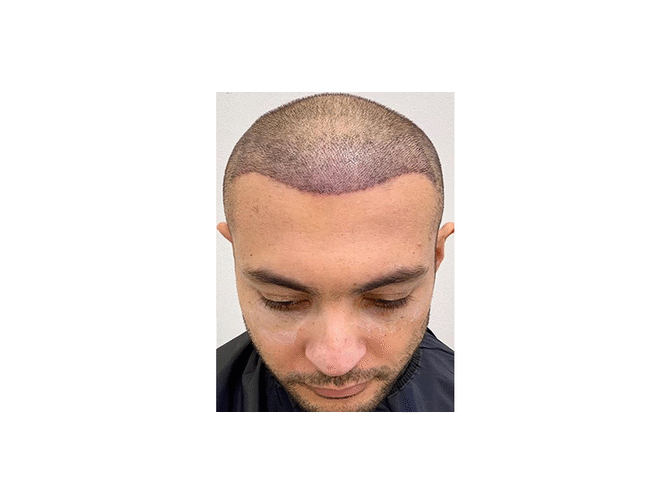 Hair Transplant Treatment