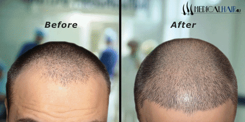 Fue Hair Transplant
